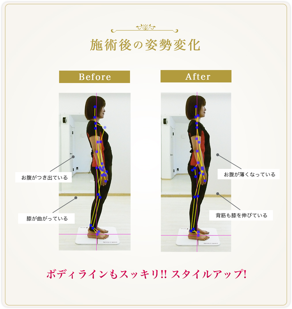 施術後の姿勢変化。1お腹がつき出ている→お腹が薄くなっている。2膝が曲がっている→背筋も膝を伸びている。